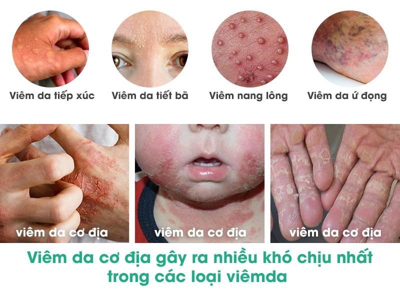 Các loại viêm da phổ biến1.jpg